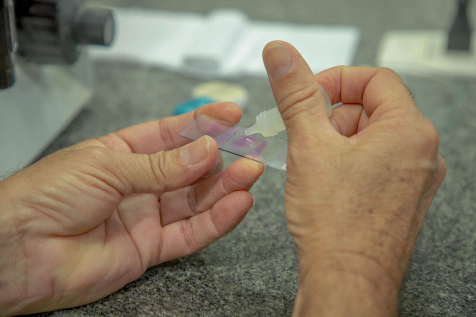 A malária é uma doença infecciosa febril aguda causada por protozoários do gênero Plasmodium